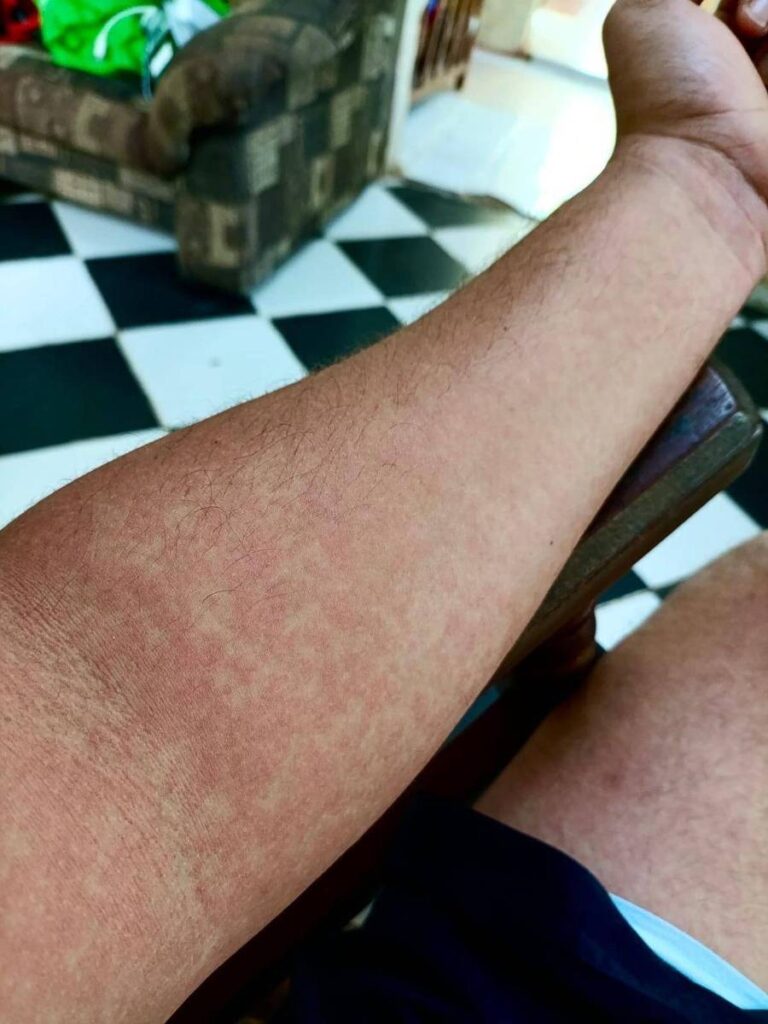 Epidemia de doenças em Cuba: um colapso alarmante