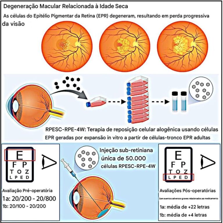 Tratamento inovador com células-tronco para degeneração macular