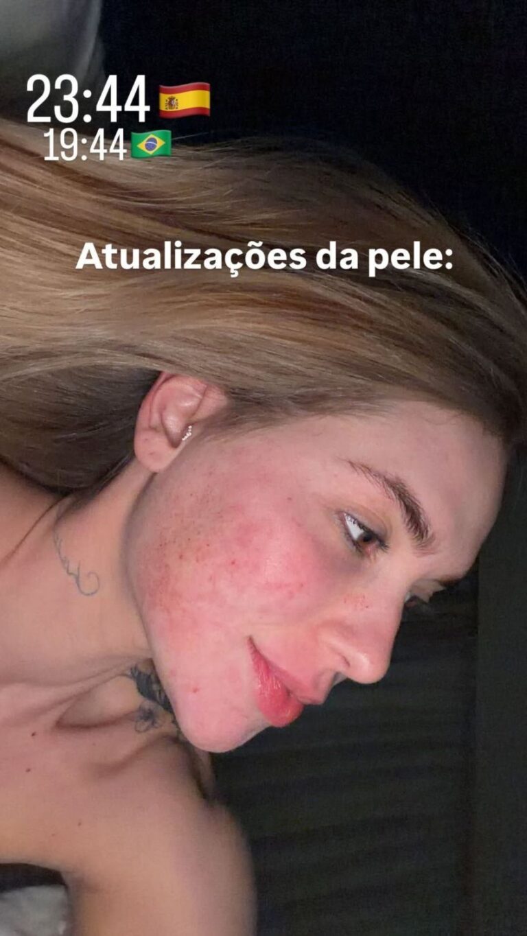 Virginia revela rosto após procedimento que deixou pele danificada