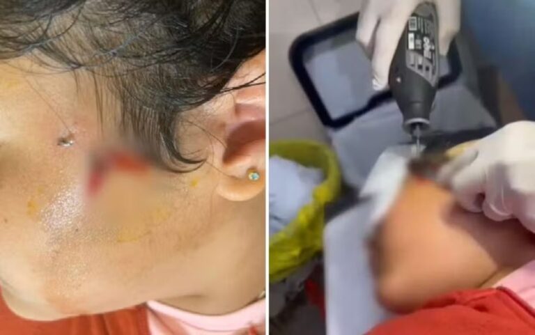 Anzol preso na bochecha de menina gera atendimento de emergência em Luziânia