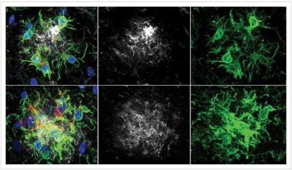 Pesquisa revela método para retardar perda de memória no Alzheimer