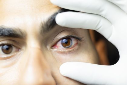 Ceratite por acanthamoeba ameaça visão de usuários de lentes de contato