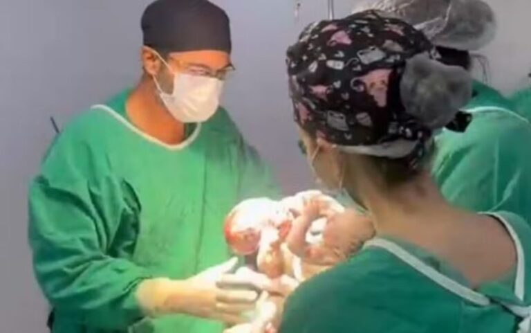 Gêmeos Siameses com Três Pernas Exigem Cirurgia Complexa em Goiânia