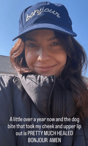 Paige Spara revela recuperação após mordida grave de cachorro no rosto