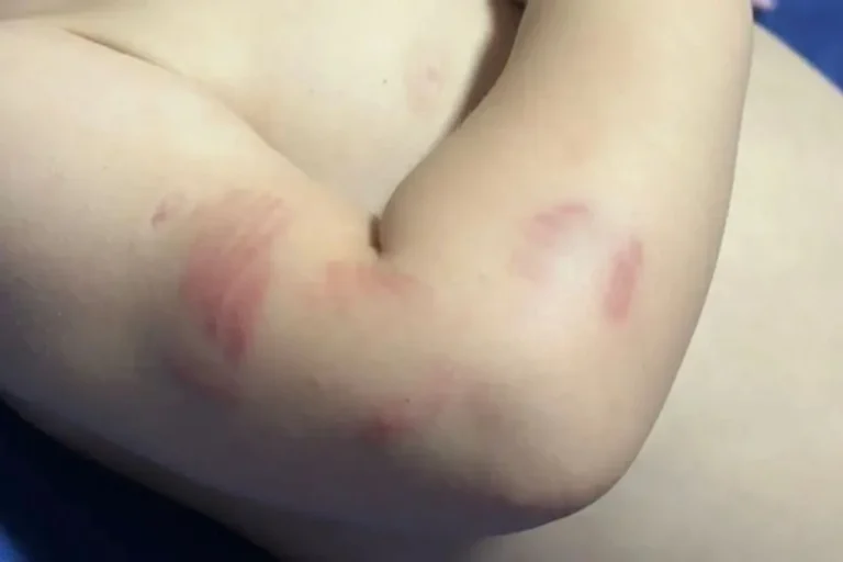 Bebê de 11 meses com mordidas na creche em Itajaí mobiliza polícia