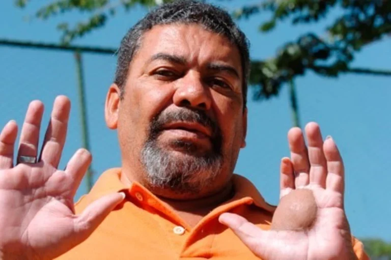 Vítima do césio-137 lamenta abordagem da netflix sobre tragédia real