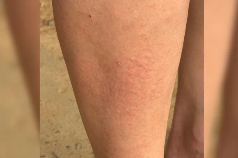 Infestação de maruim em Ilhota leva moradores a usar luvas no calor