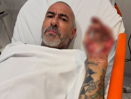 Chef Henrique Fogaça expõe feridas de acidente e denuncia roubo
