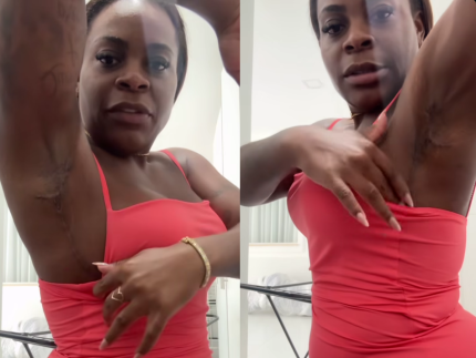 Jojo Todynho mostra cicatrizes de novo procedimento cirúrgico