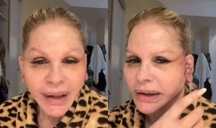 Monique Evans enfrenta perrengue com banco após cirurgia facial